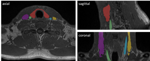 MRI example with multiple labels